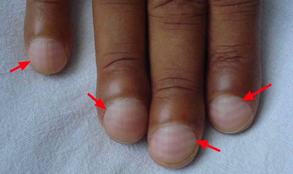 Nguy cơ mất chức năng phổi nếu không kiểm soát kịp thời biến chứng