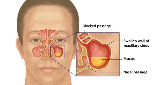 Sử dụng sản phẩm thảo dược hỗ trợ cải thiện nghẹt mũi kéo dài