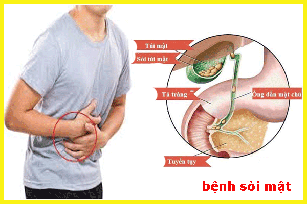 Tìm hiểu nguyên nhân hình thành bệnh sỏi mật