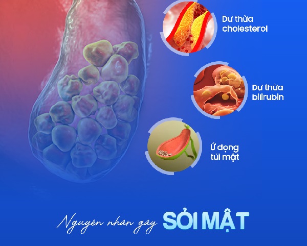 Các nguyên nhân khiến sỏi mật hình thành