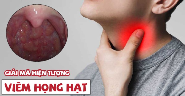 Dấu hiệu nhận biết viêm họng hạt