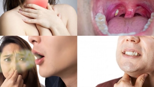 Điều trị viêm họng hạt bằng thảo dược