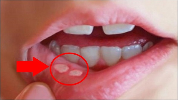 Nhiệt miệng liên tục không hết cảnh báo vấn đề gì