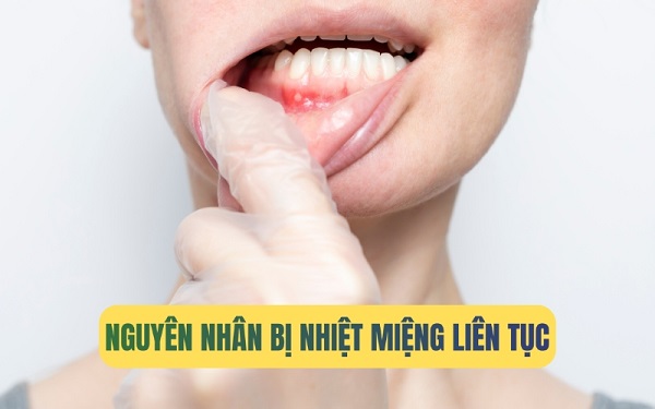 Nguyên nhân và yếu tố gây nhiệt miệng kéo dài