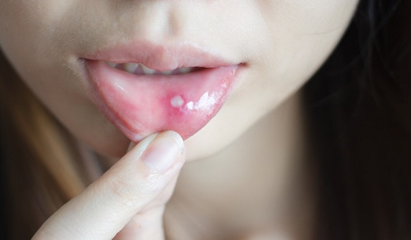 Nhiệt miệng cảnh báo các bệnh nguy hiểm