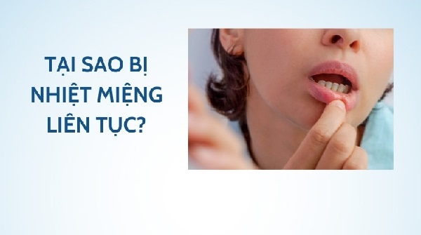 Phương pháp điều trị và phòng ngừa nhiệt miệng