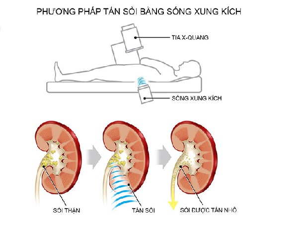 phương pháp làm tan sỏi thận và sỏi mật an toàn