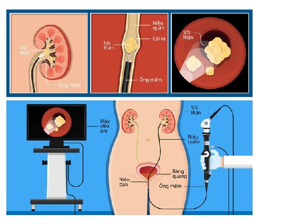 Các vị thuốc nam hỗ trợ tan sỏi thận, sỏi mật