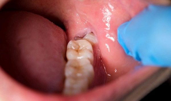 Hình ảnh minh họa răng khôn mọc lệch gây đau nhức và viêm sưng