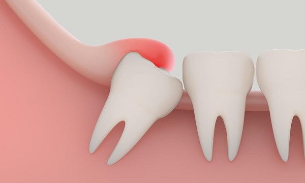 Tác hại khi tự ý trì hoãn điều trị răng khôn mọc lệch
