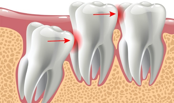 Bảo vệ sức khỏe răng miệng với quyết định hợp lý về răng khôn