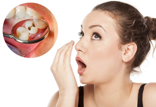 Sâu răng và hôi miệng - cảnh báo sức khỏe không nên xem nhẹ