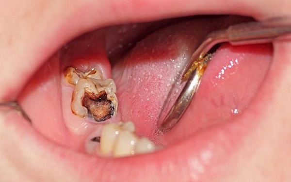 Sâu răng có thể làm tăng nguy cơ bệnh lý nghiêm trọng khác