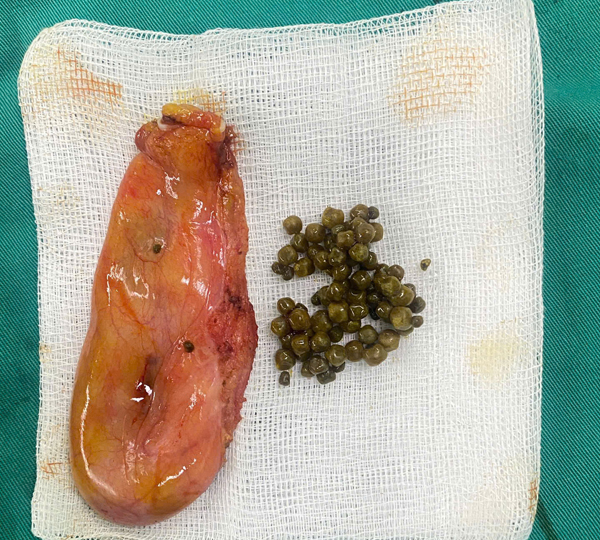 Minh họa quy trình siêu âm xác định kích thước sỏi mật