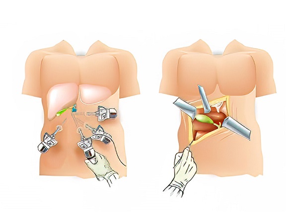 Hình ảnh chế độ ăn uống và lối sống lành mạnh giúp ngăn ngừa sỏi mật