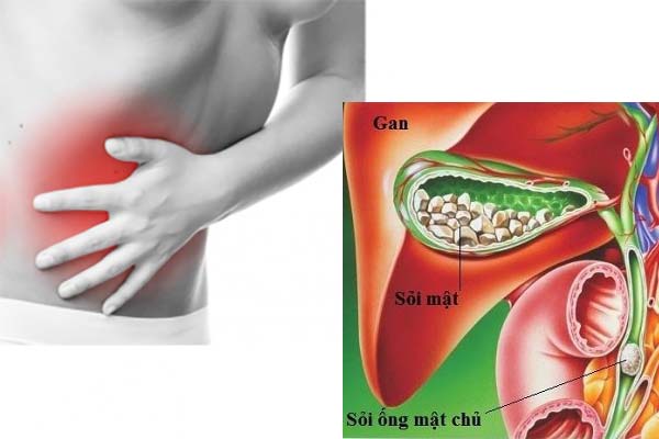 Giải pháp hỗ trợ điều trị và phòng ngừa sỏi mật bằng thảo dược thiên nhiên