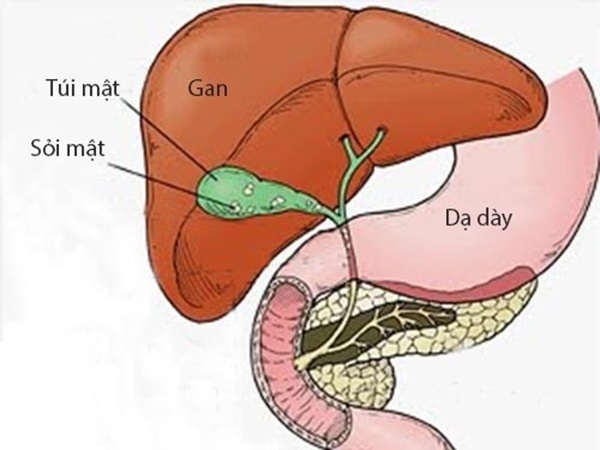 Hình ảnh thể hiện bệnh sỏi mật dễ bị nhầm lẫn với bệnh tiêu hóa