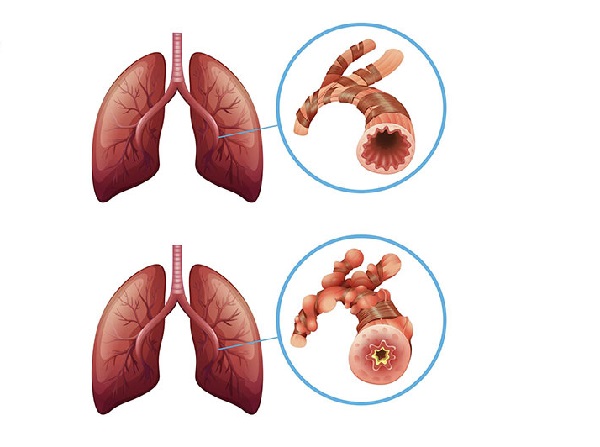 Thảo dược hỗ trợ điều trị bệnh phổi từ Tấn Phát