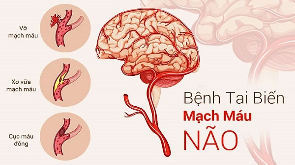 Hình ảnh minh họa tế bào não bị tổn thương bởi tai biến mạch máu não
