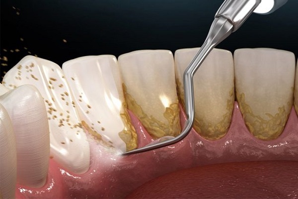 Hình ảnh bác sĩ nha khoa cạo vôi răng cho bệnh nhân