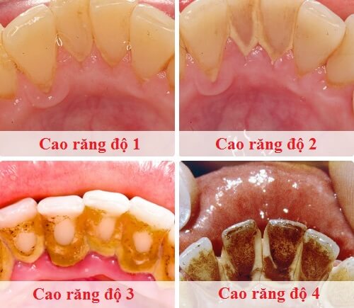 Minh họa quá trình hình thành vôi răng