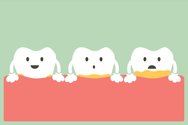 Lợi ích sau khi cạo vôi răng