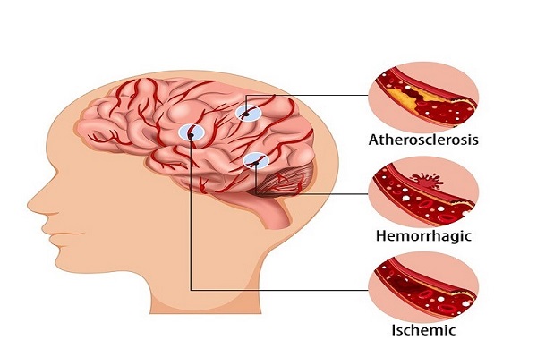 Thảo dược thiên nhiên giúp cải thiện tuần hoàn máu não và trí nhớ