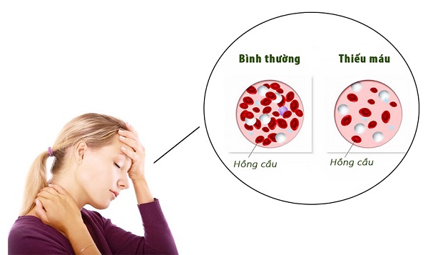 Hình ảnh mô tả tình trạng thiếu máu do thiếu sắt và vitamin B ở người lớn và trẻ em