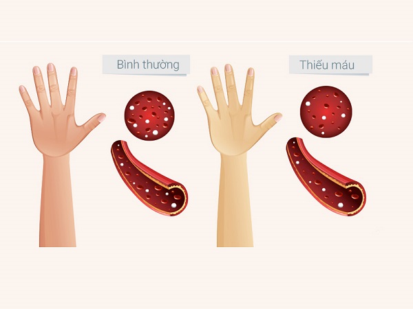 Các vấn đề về thiếu sắt và dư sắt do dinh dưỡng