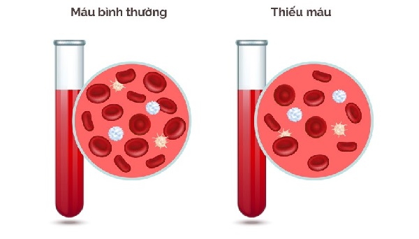 Lời khuyên cân bằng lượng sắt qua dinh dưỡng