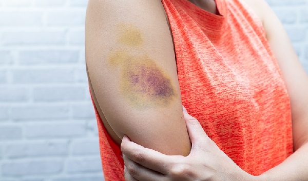 Hậu quả của thiếu vitamin C