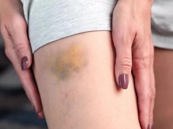 Ca thực tế thiếu vitamin C ở trẻ