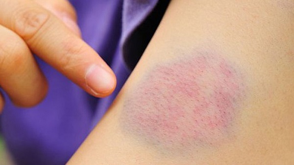 Triệu chứng và hậu quả thiếu vitamin