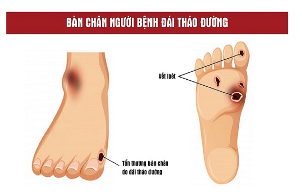 Rủi ro khi tự ý điều trị tiểu đường