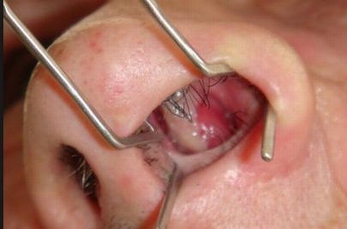 Nguyên nhân polyp mũi ở trẻ nhỏ