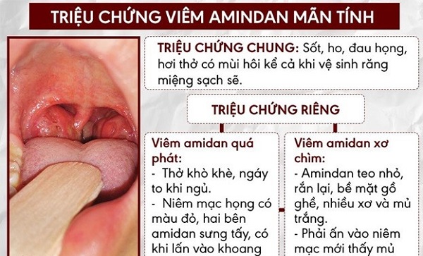 Dấu hiệu viêm amidan phổ biến ở vùng họng