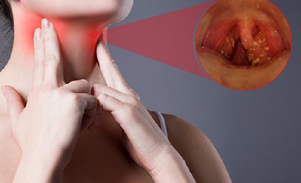 Mảng trắng ở amidan cảnh báo viêm nhiễm