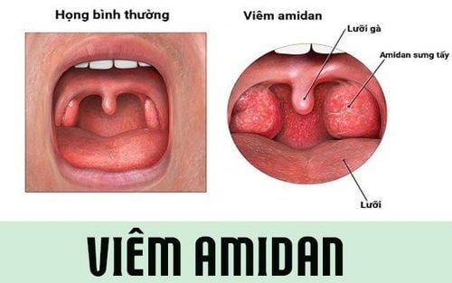 So sánh triệu chứng viêm amidan và các bệnh tai mũi họng khác