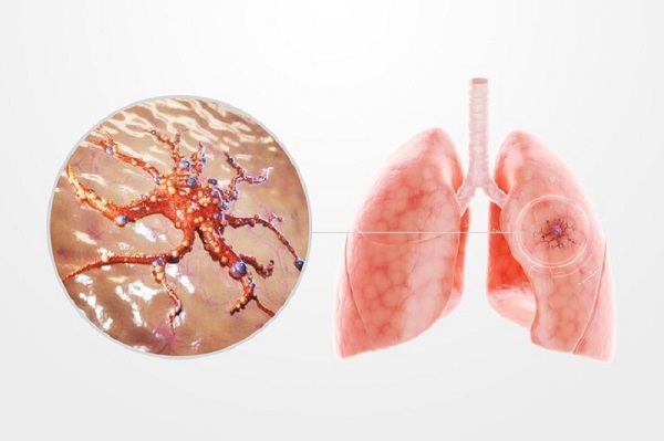 Thảo dược thiên nhiên hỗ trợ chăm sóc phổi