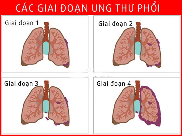 Hình ảnh minh họa về bệnh ung thư phổi
