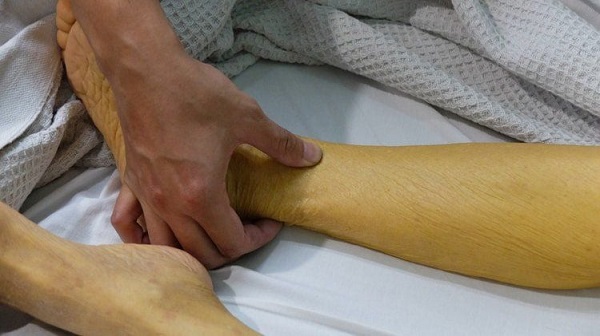 Vàng da, vàng mắt có phải là dấu hiệu của bệnh sỏi mật