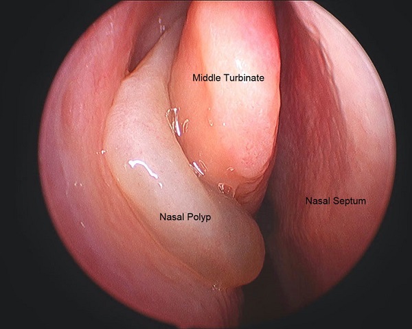 Thảo dược hỗ trợ điều trị polyp mũi an toàn