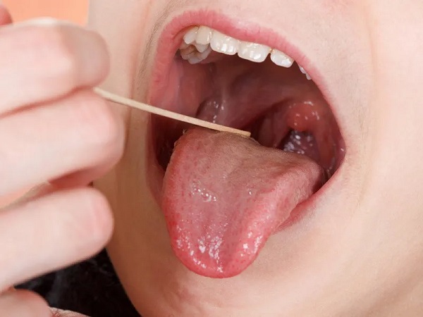 Viêm amidan nguy hiểm như thế nào?