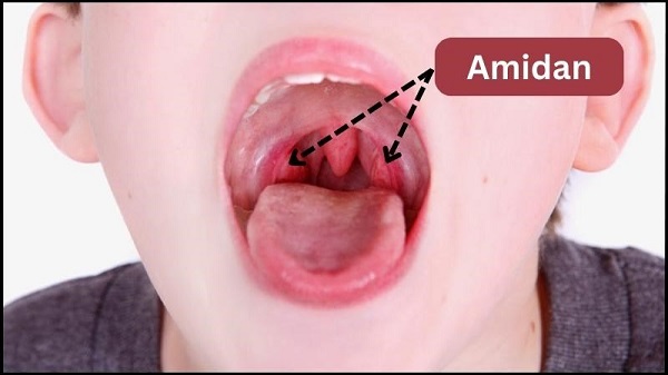 Triệu chứng viêm amidan dễ nhận biết