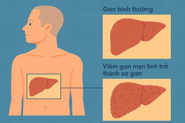 Sự khác biệt giữa viêm gan và xơ gan