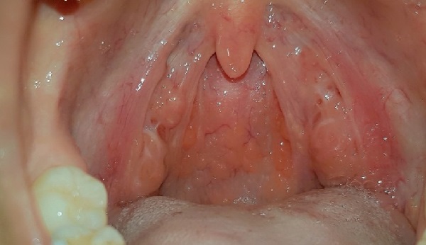 Viêm họng hạt là gì, hình ảnh mô tả thực tế viêm họng hạt