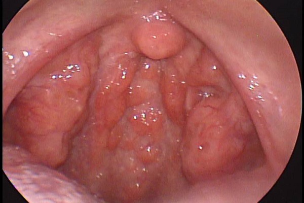 Triệu chứng viêm họng hạt và mối liên hệ với bệnh tai mũi họng