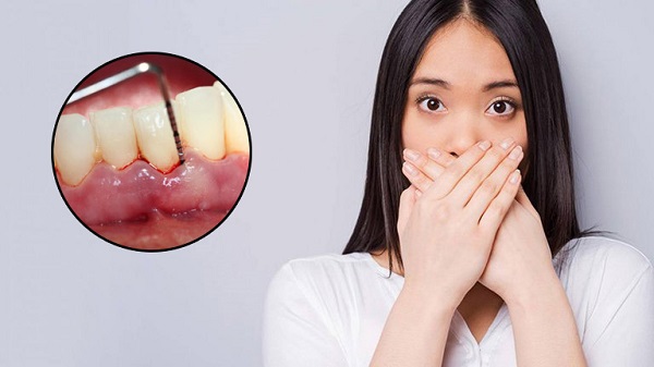 Viêm lợi, viêm nha chu gây hôi miệng
