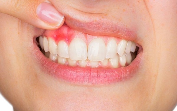 Bệnh răng miệng và nguy cơ viêm phổi