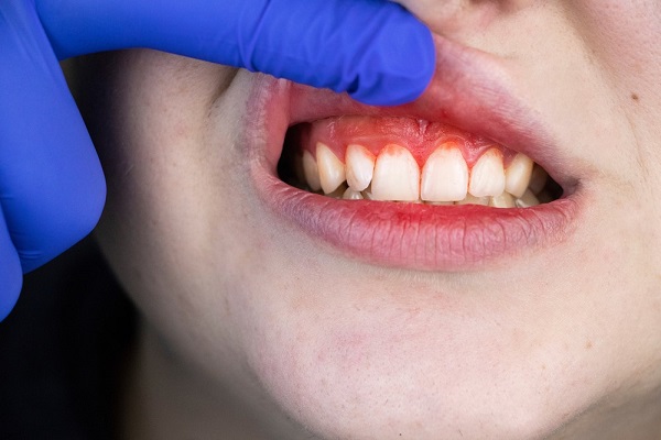 Giải pháp phòng ngừa viêm lợi, nha chu và viêm phổi